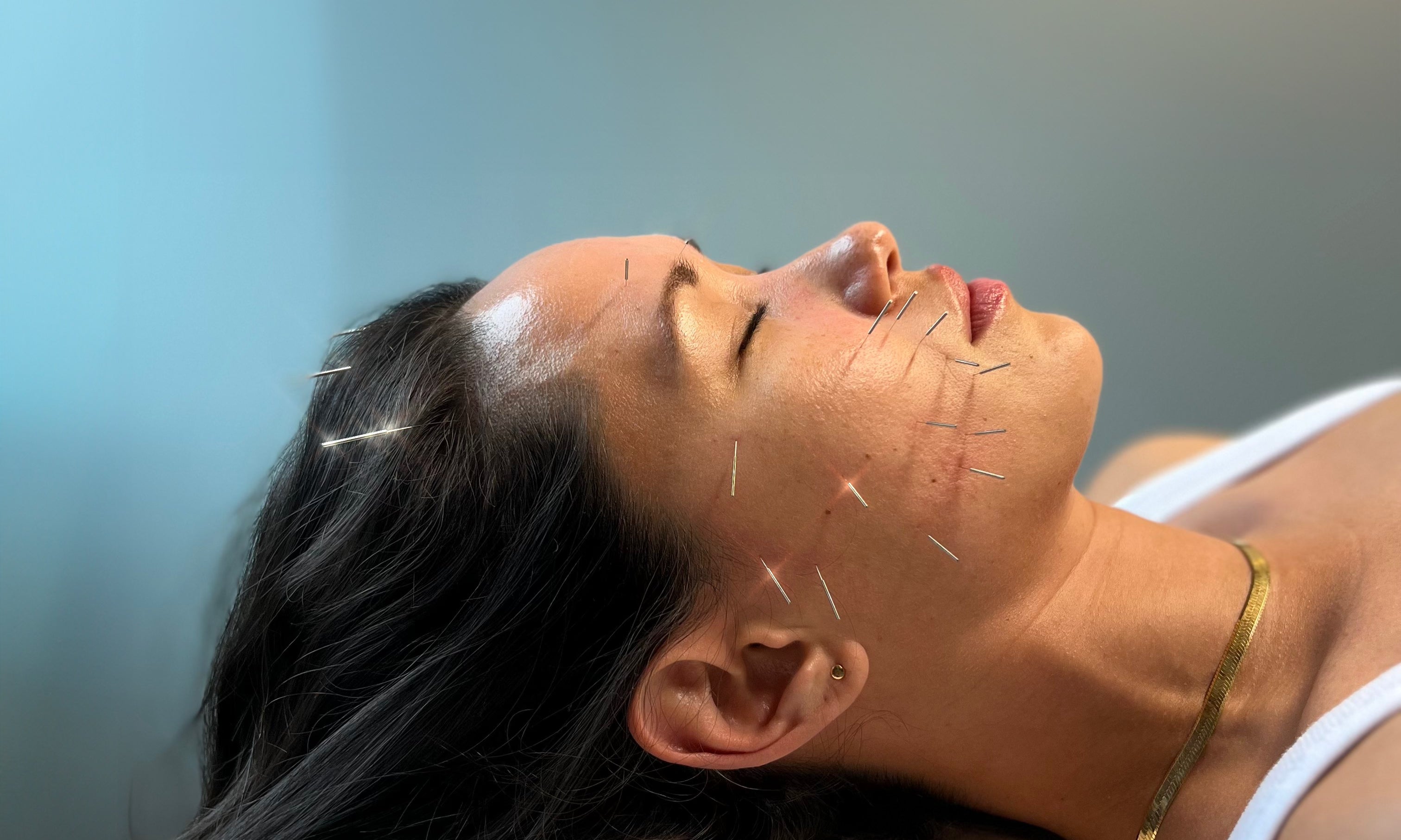 Woman receiving facial acupuncture treatment for natural skincare in Toronto