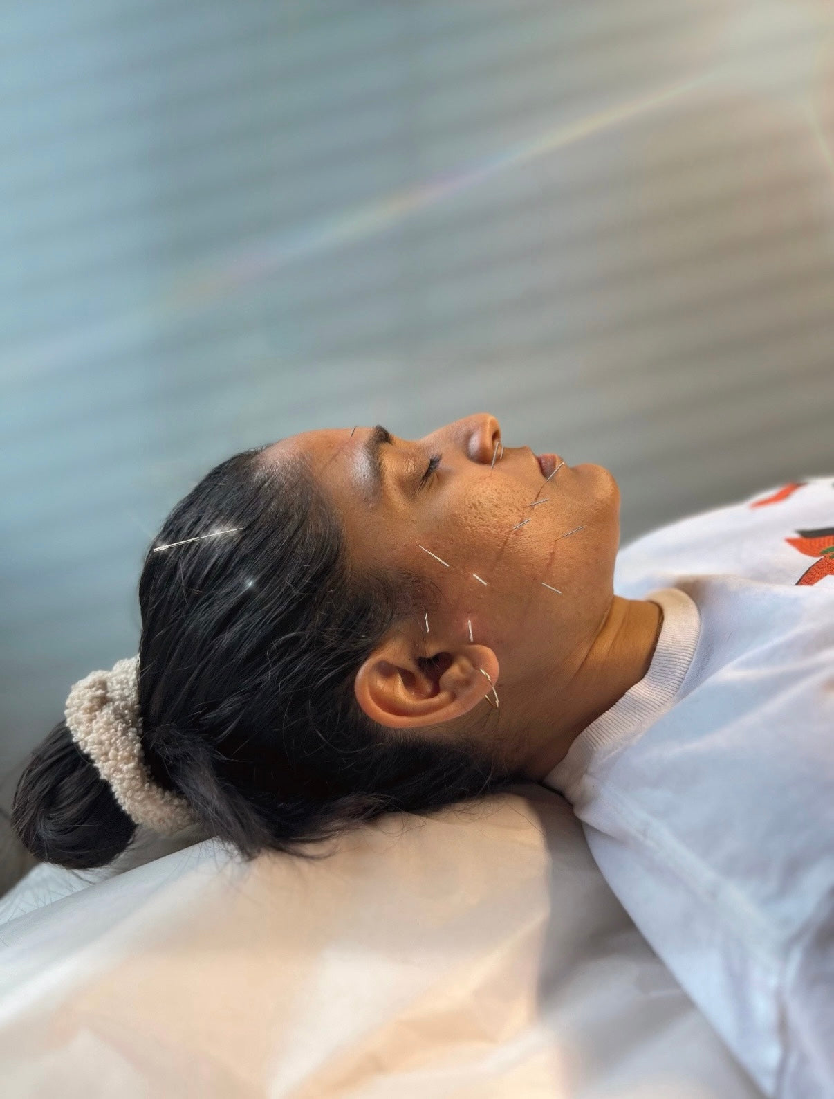 Person receiving acupuncture with needles on the face against a neutral background